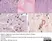 Anti Borrelia burgdorferi Antibody thumbnail image 1